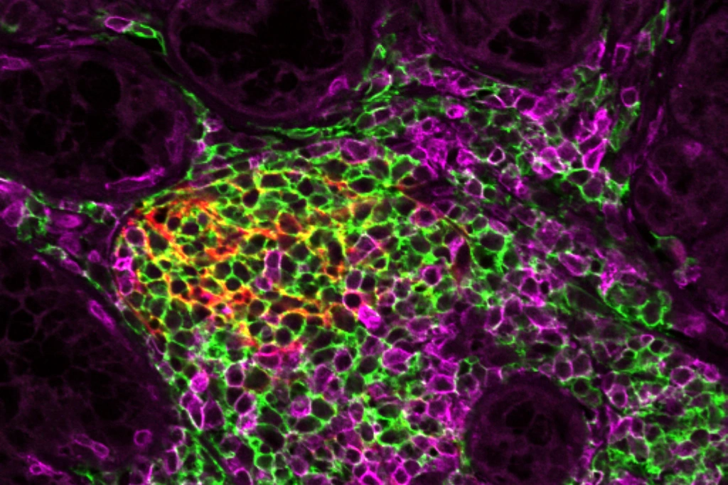 Tertiary lymphoid structure in minor salivary gland in Sjoegren’s disease patient. Confocal microscopy image: CD20 (B cells) in green, CD21 (follicular dendritic cells) in red and CD3 (T cells) in magenta